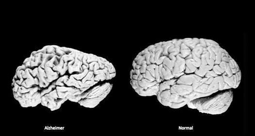 Nexweşiya Alzheimerê